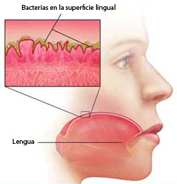 Halitosis bacteriana