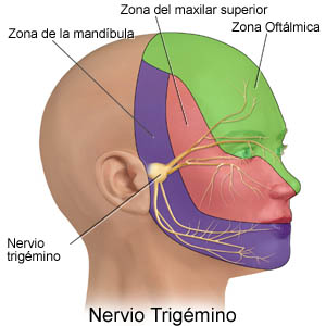 Neuralgia Trigemio