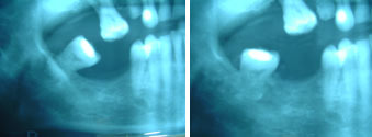 Regeneración de malposición dentarias