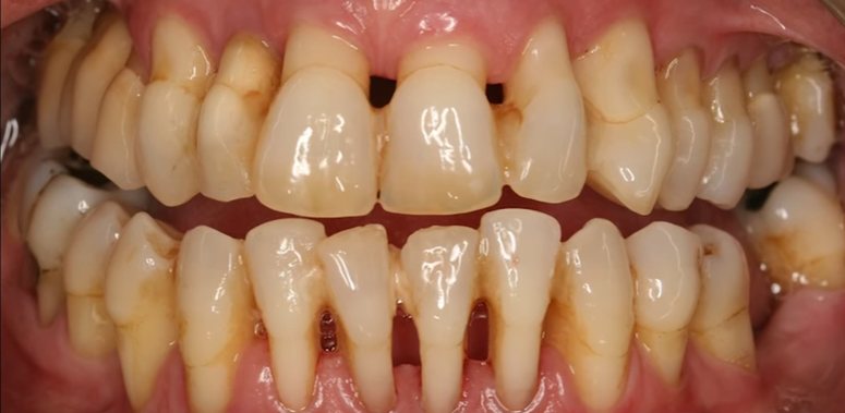 Enfermedad Periodontal