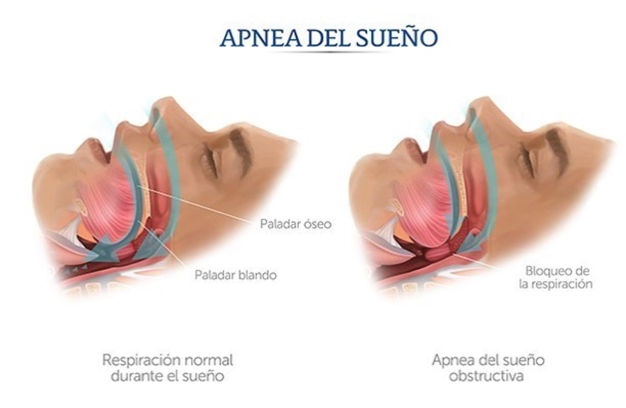 Qué es la Apnea obstructiva del sueño